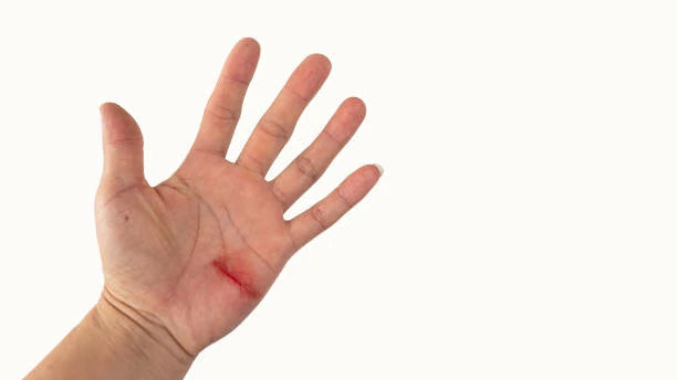 Exercise a Sprained Finger: Accelerating Recovery and Restoring Mobility