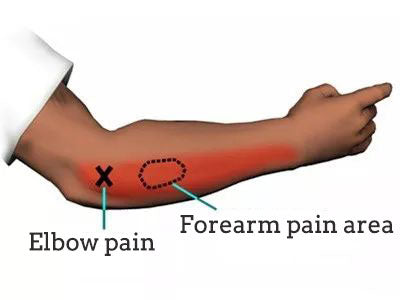 tennis elbow
